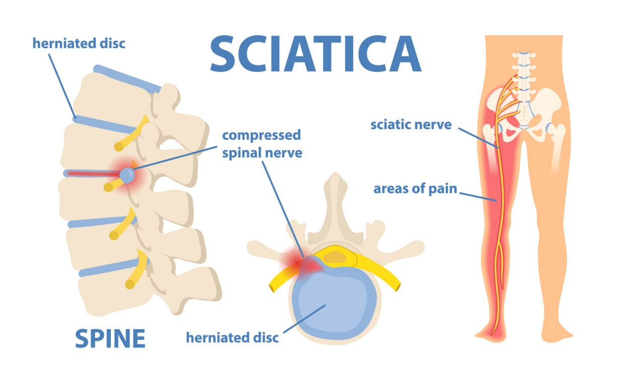 Diagram showing how a herniated disc can compress the sciatic nerve and cause sciatic pain that travels from the lower back down the leg.
